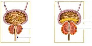 Mga uri at anyo ng prostatitis sa mga kalalakihan