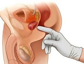 Prostate massage para sa paggamot ng prostatitis sa mga kalalakihan