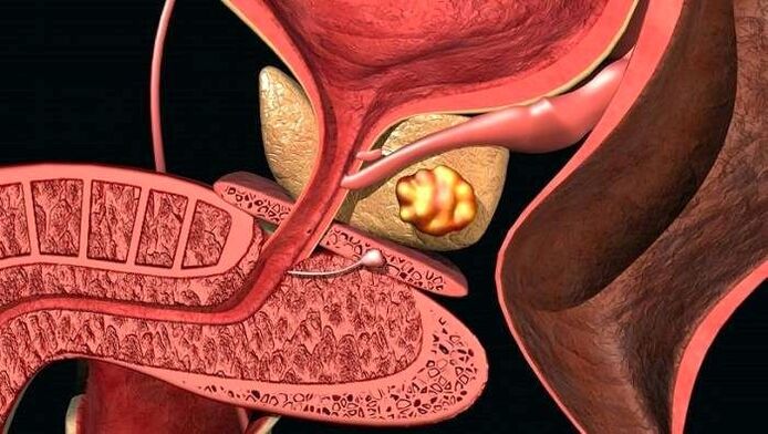 Mga deposito ng bato sa prostate na may calculous prostatitis