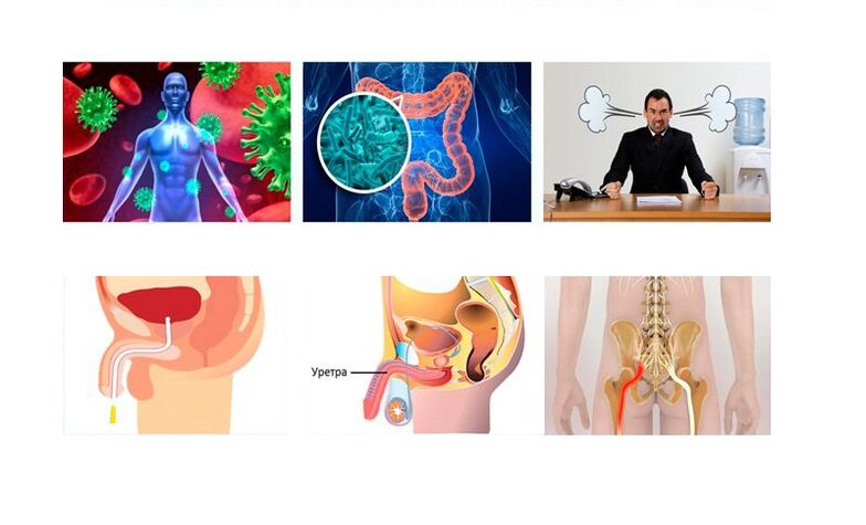 sanhi ng prostatitis