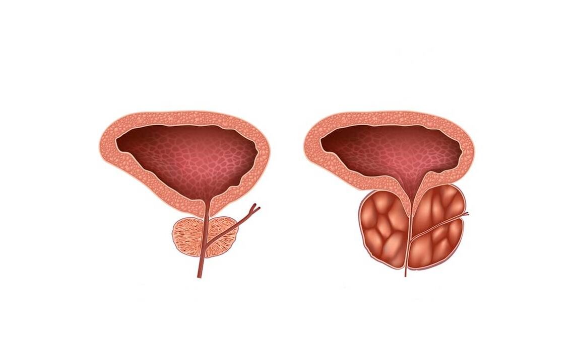 sintomas ng prostatitis sa mga lalaki