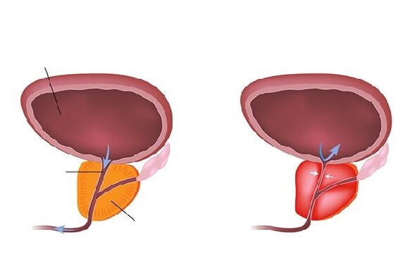 normal at inflamed prostate