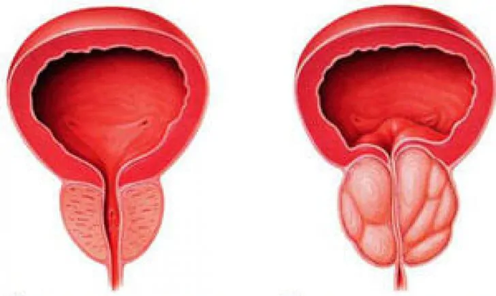 Normal na prostate (kaliwa) at inflamed chronic prostatitis (kanan)